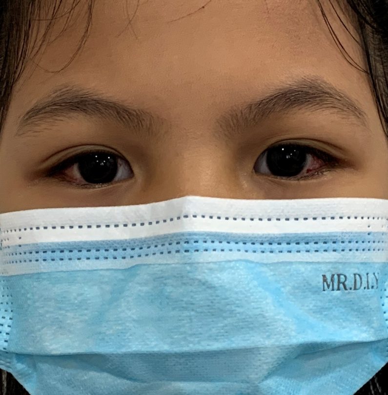 Patient Mia eyesight improvements after the squint surgery